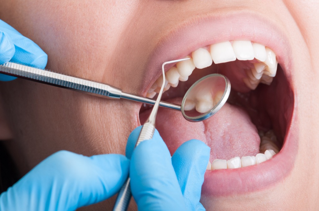 Dentist,Cleaning,Perfect,Teeth,Of,A,Beautiful,Mouth,Female