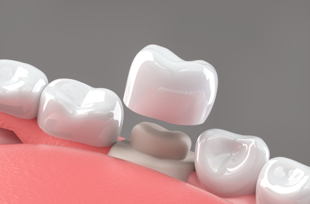 Dental Crowns versus Cavity Fillings Treatment in Lancaster