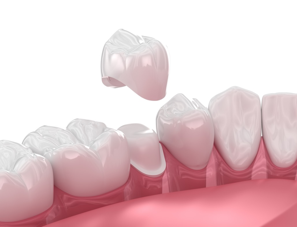 Dental,Crown,Placement,Over,Tooth.,3d,Illustration