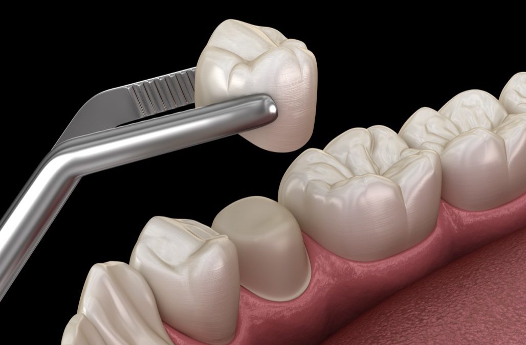 Dental Crowns Near Me in Lancaster