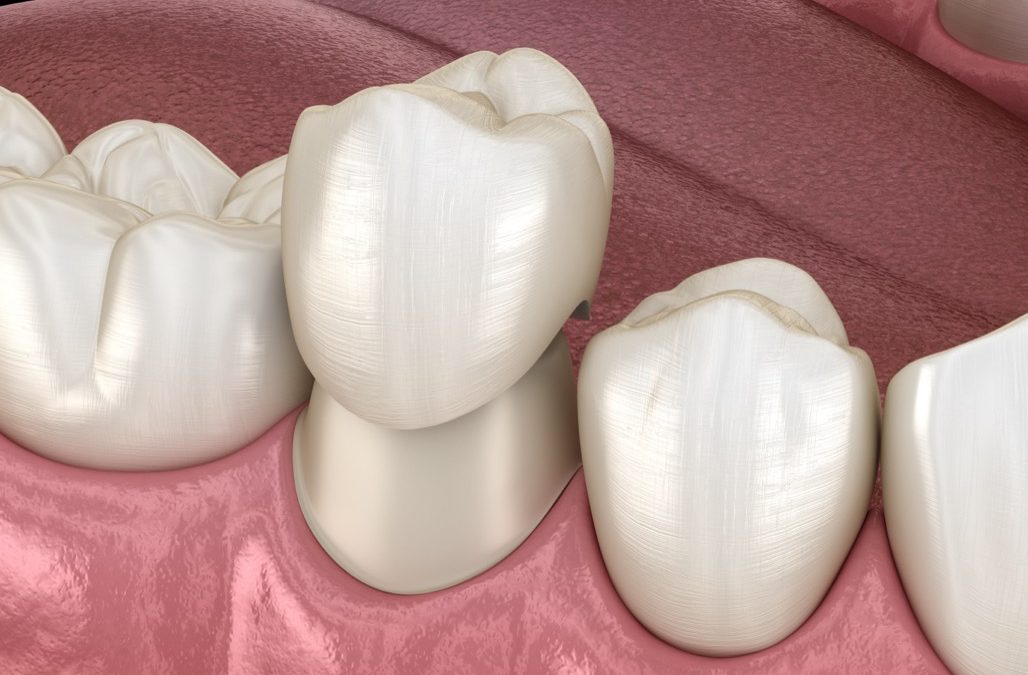 Dental Crowns Versus Cavity Fillings Treatment Near Me in Lancaster