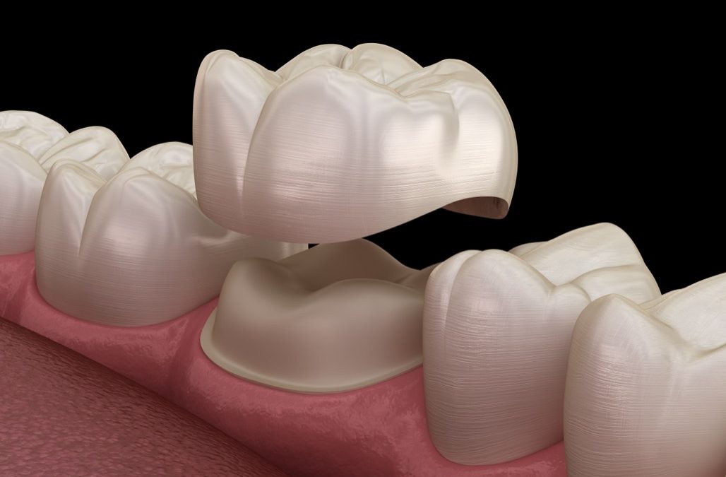 Dental Crowns Near Me in Lancaster