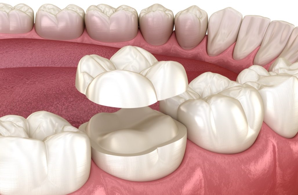 Dental crowns Fillings to Improve Dental Health Near Me in Lancaster