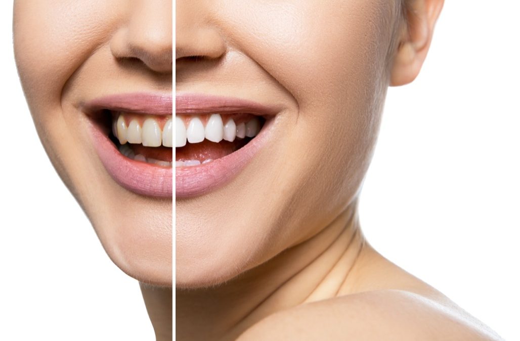 Teeth Whitening Treatment Near Me in Lancaster