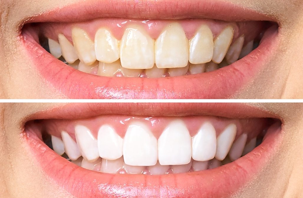 Teeth Cleaning & Exam Near Me in Lancaster, CA