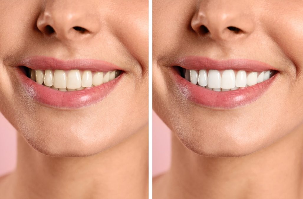 Teeth Whitening Treatment in Lancaster
