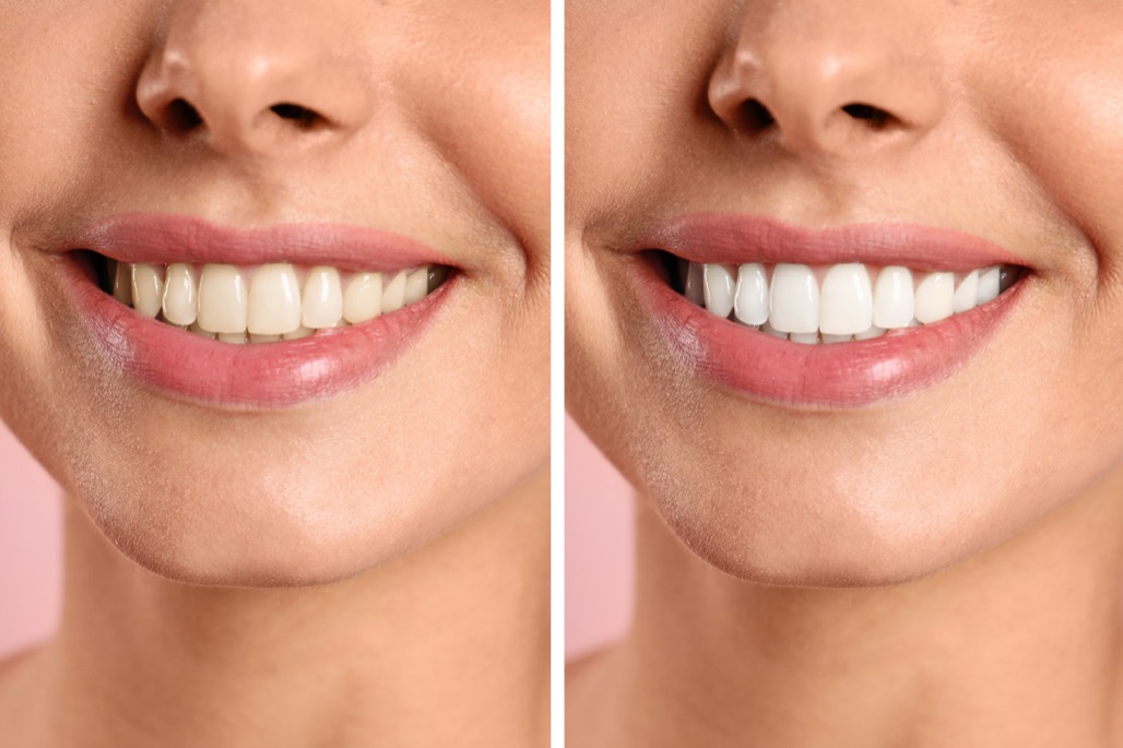 Smiling,Woman,Before,And,After,Teeth,Whitening,Procedure,,Closeup