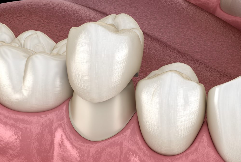 Dental Crowns for Tooth Replacement & Cosmetic Purposes | Lancaster CA