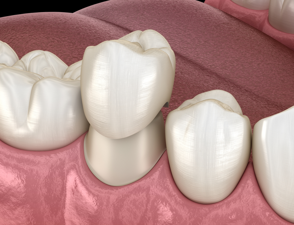 Dental,Crown,Premolar,Tooth,Assembly,Process.,Medically,Accurate,3d,Illustration