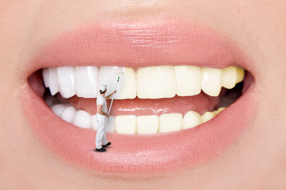 Perfect,Smile,Before,And,After,Bleaching.,Dental,Care,And,Whitening